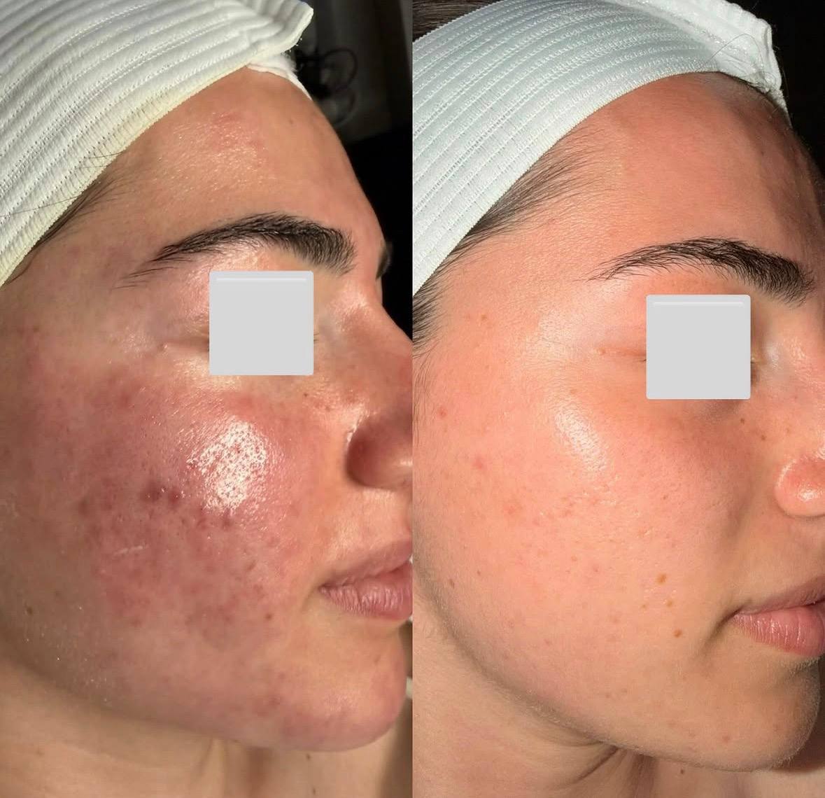 Acne scarring treatment results
